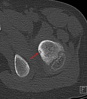 Osteoma osteoide