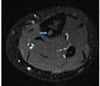 Osteoma osteoide del fémur (RM)