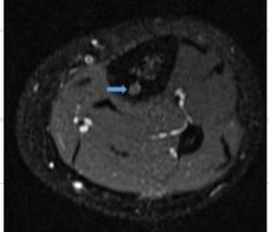 Osteoma osteoide del fémur (RM)