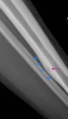 Osteoma osteoide del fémur (radiografía)
