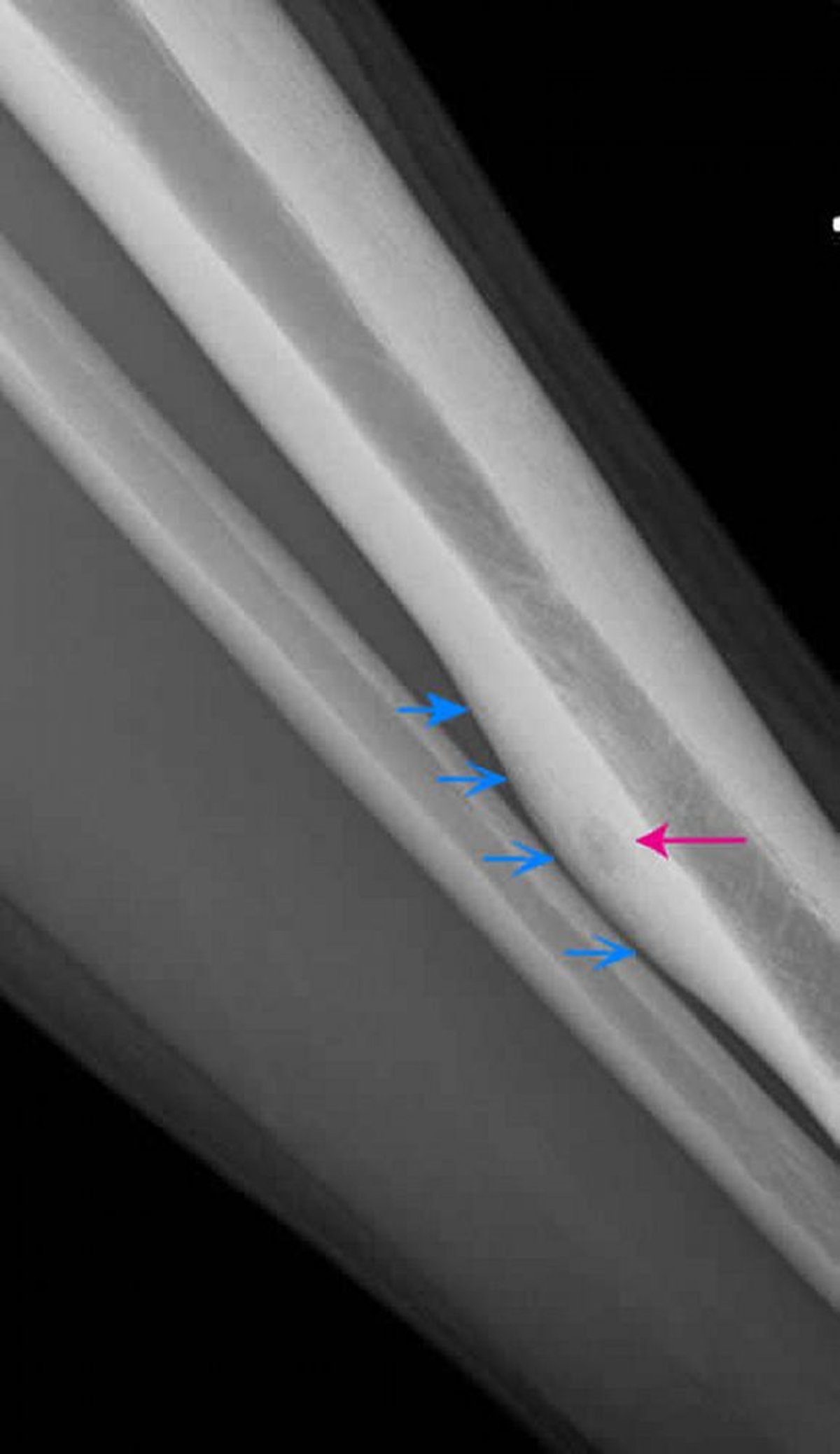 Osteoma osteoide del fémur (radiografía)