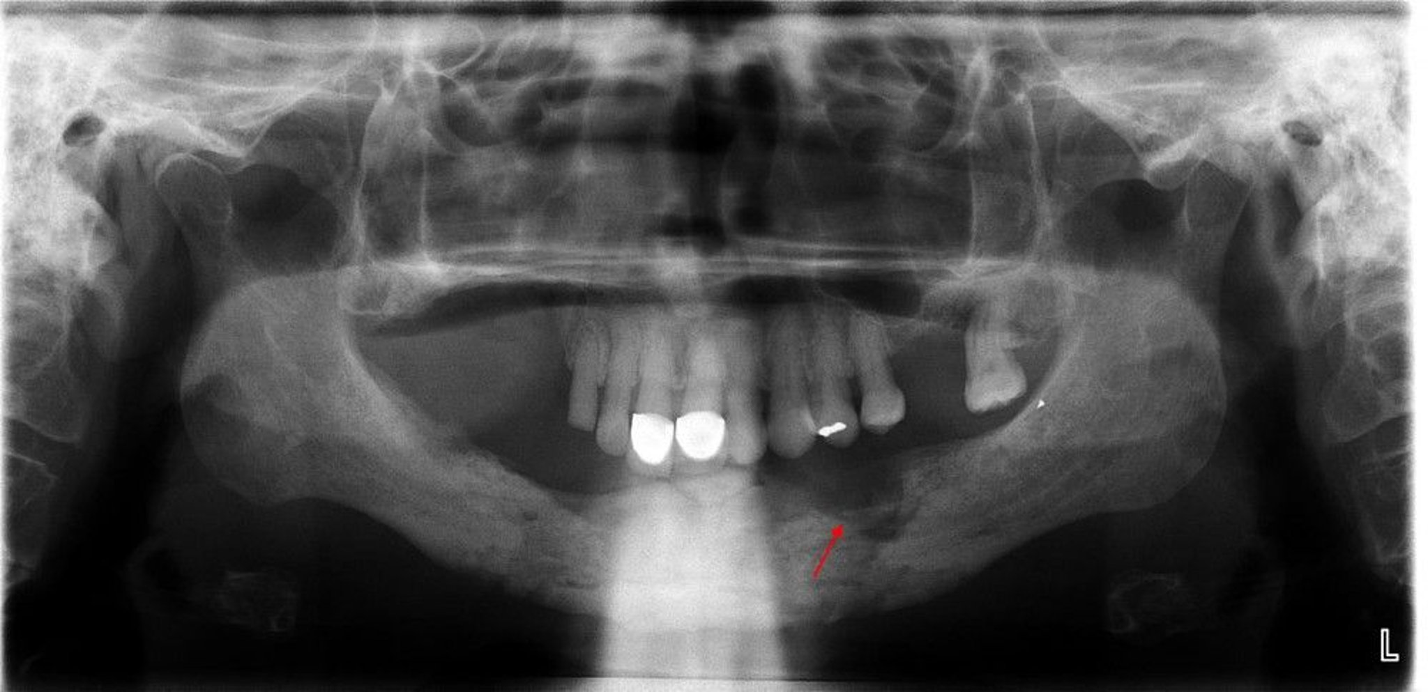 Osteomyelitis