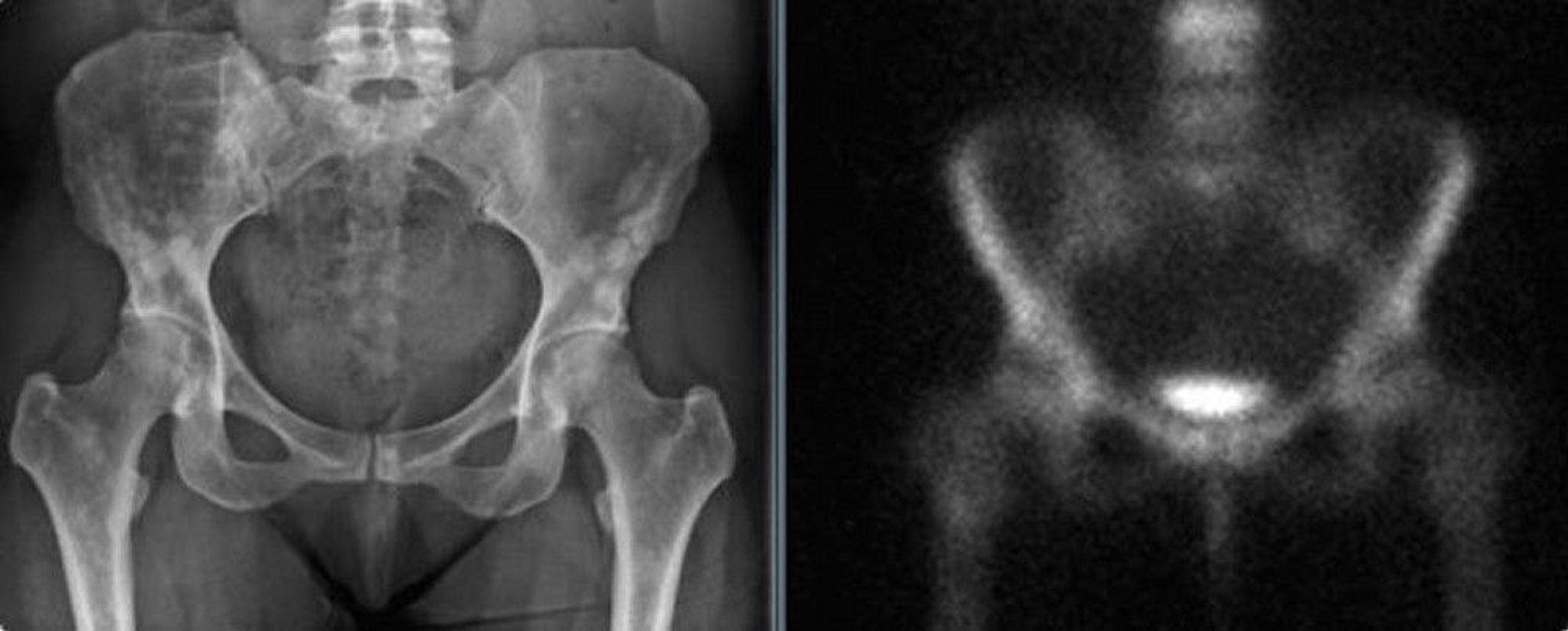 Osteopoikilosis of the Pelvis
