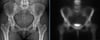 Osteopoiquilosis de la pelvis