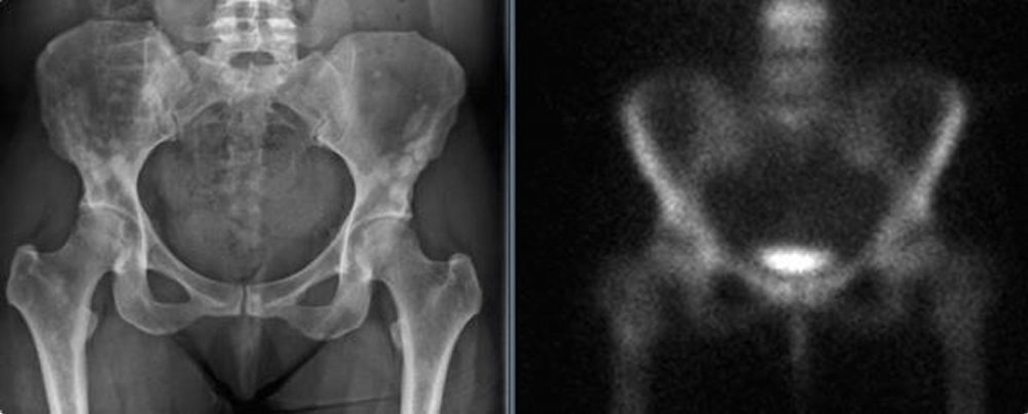 Osteopoiquilose da pelve