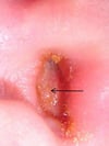 Otite externe avec furoncle