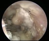 Otomycosis