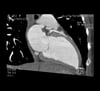 Herz-CT-Angiogramm