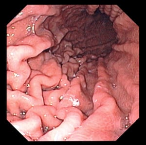 Endoscopy (Stomach)