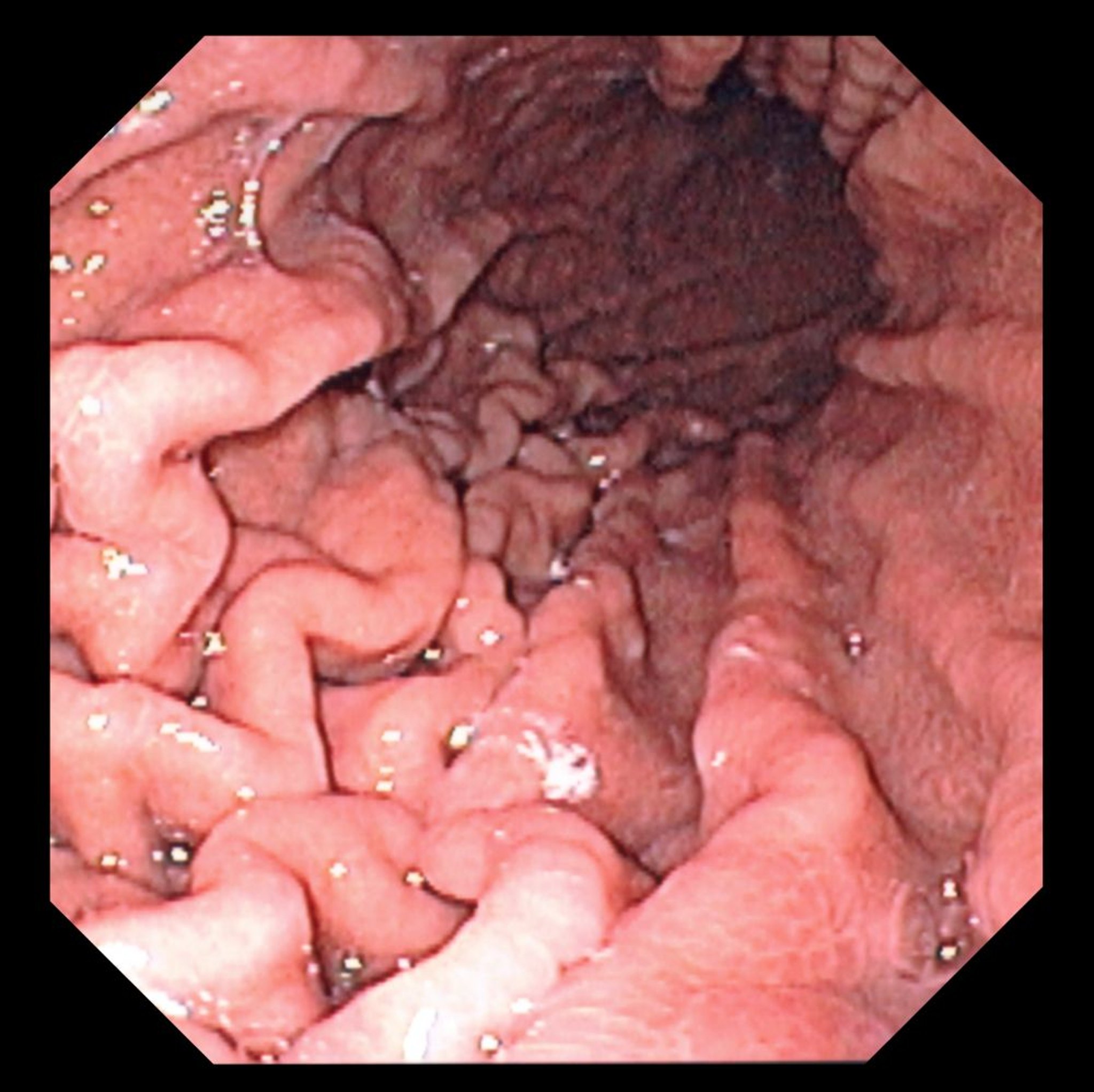 Endoscopie (estomac)