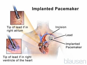 Implanted Pacemaker