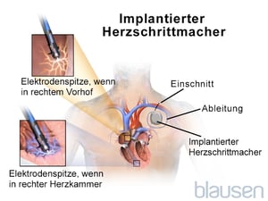 Implantierter Schrittmacher