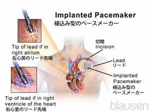 植込み型ペースメーカー