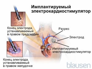 Имплантируемый электрокардиостимулятор