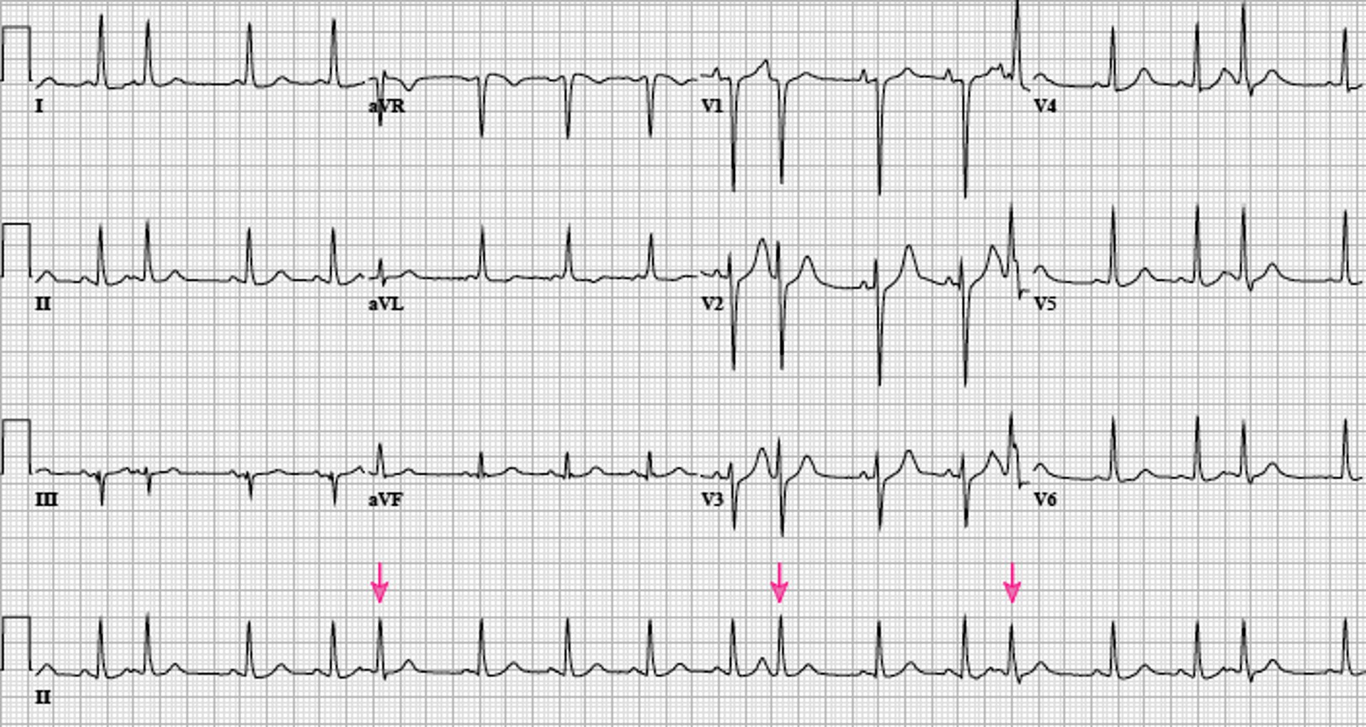 Sinus Rhythm With Atrial Premature Beats (Arrows)