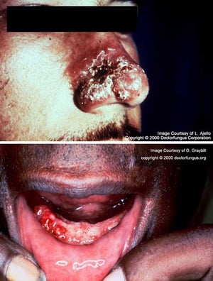 Паракокцидиоидомикоз (кожно-слизистые язвы)
