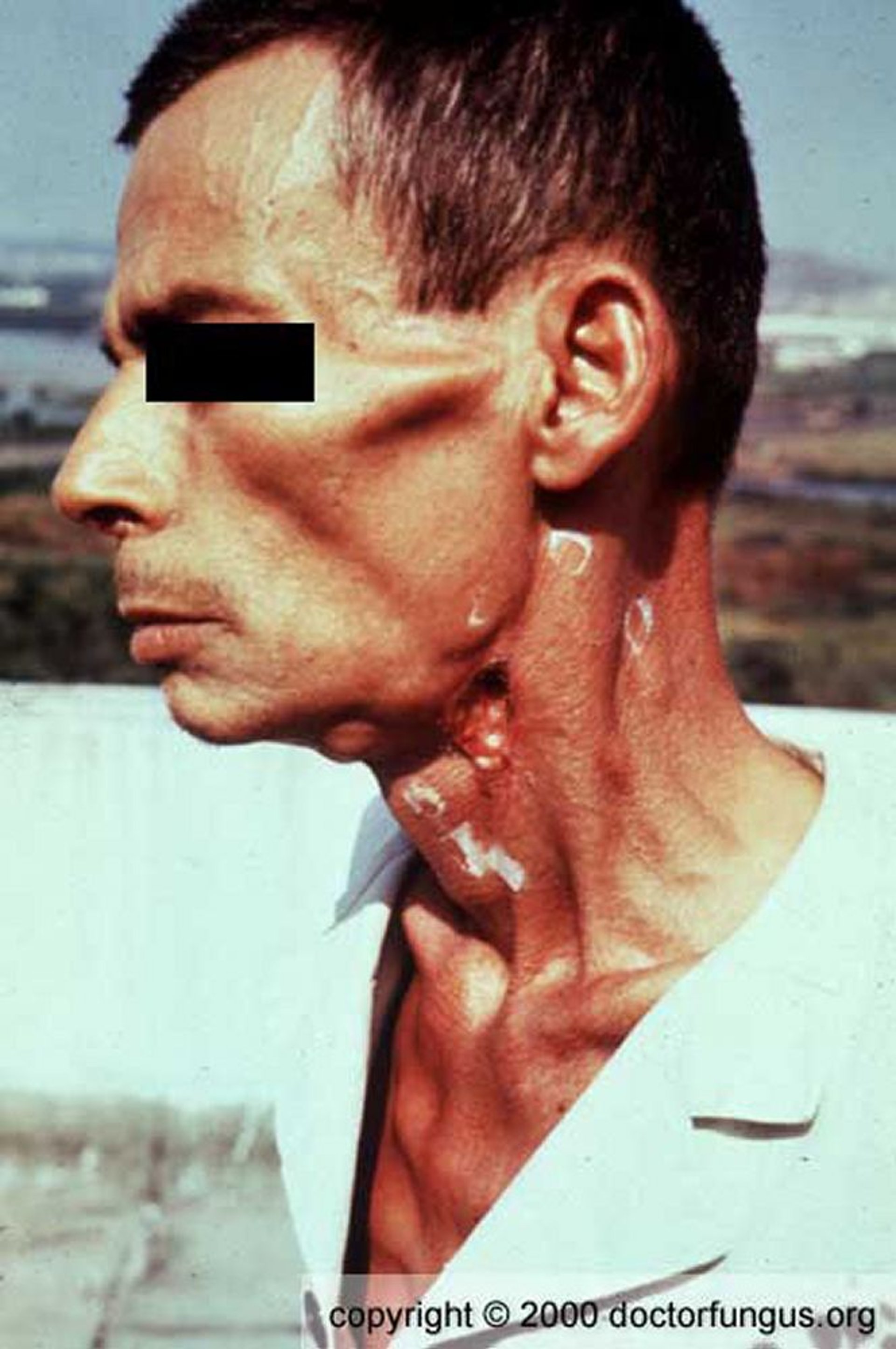 Paracoccidioïdomycose (cou)