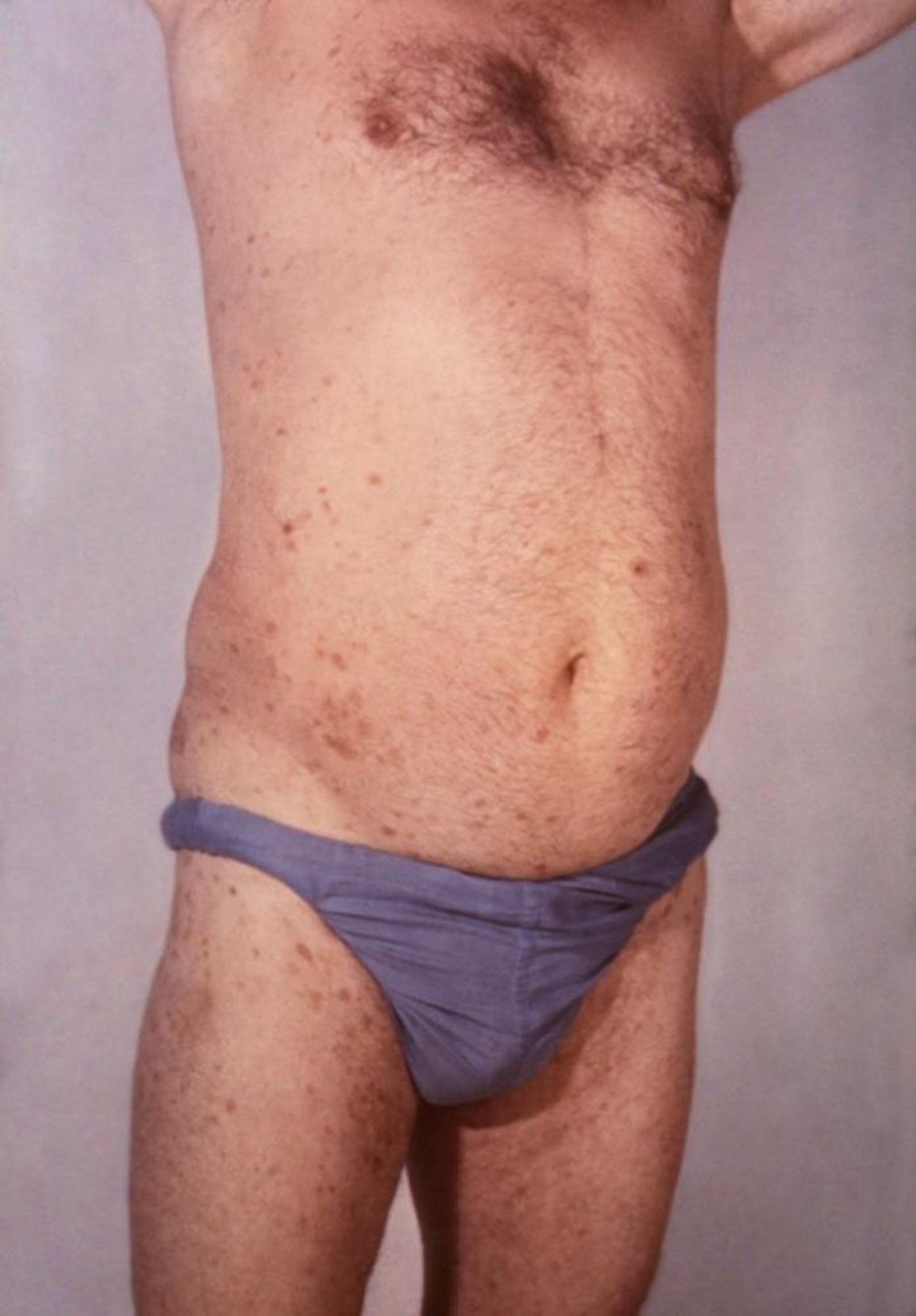 Small-Plaque Parapsoriasis