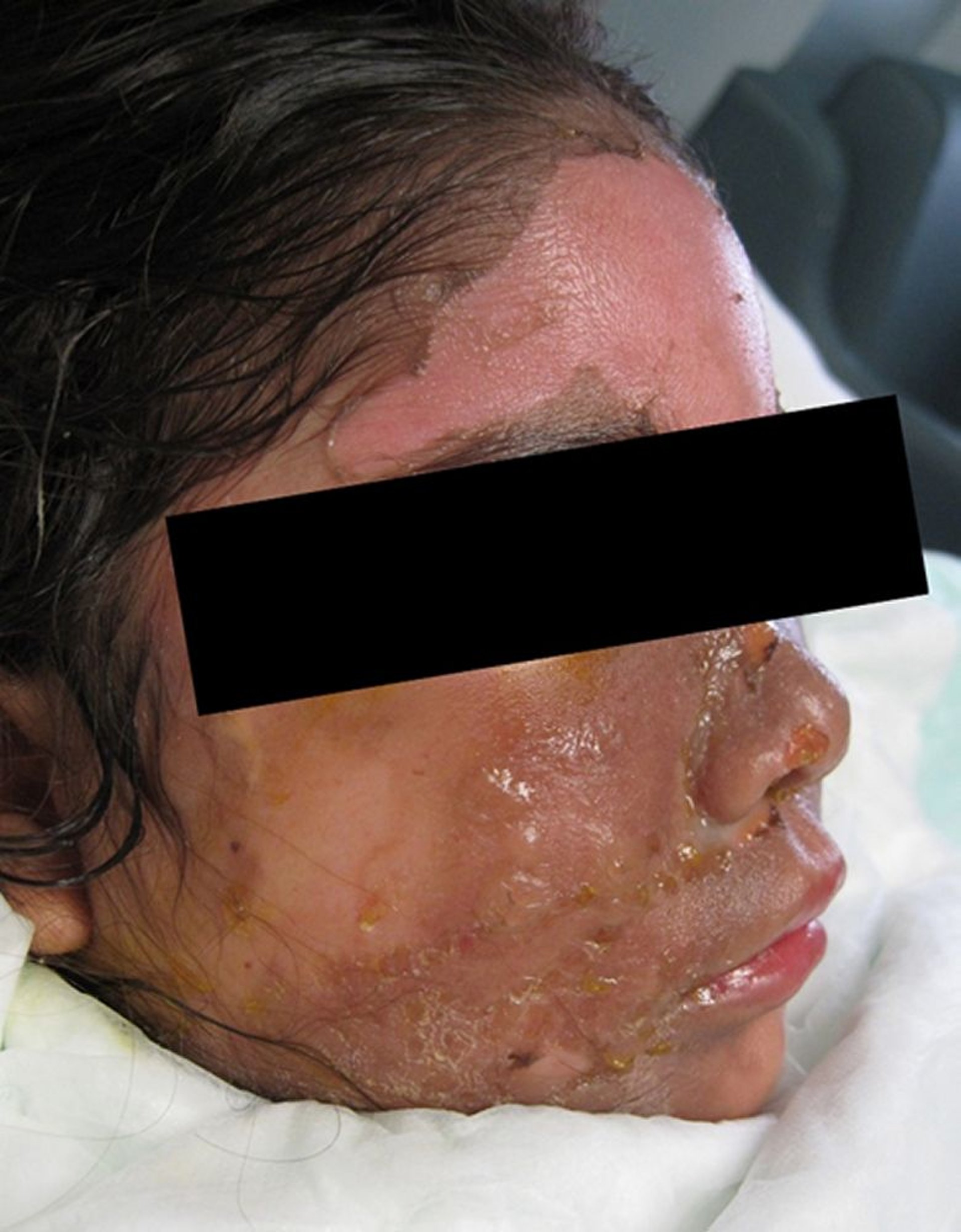 Bỏng một phần độ dày (độ 2)