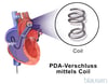 Spiralverschluss eines persistierenden Ductus arteriosus