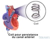 Fermeture de la membrane du canal artériel perméable par microspires (coils)