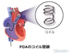 動脈管開存症のコイル塞栓術