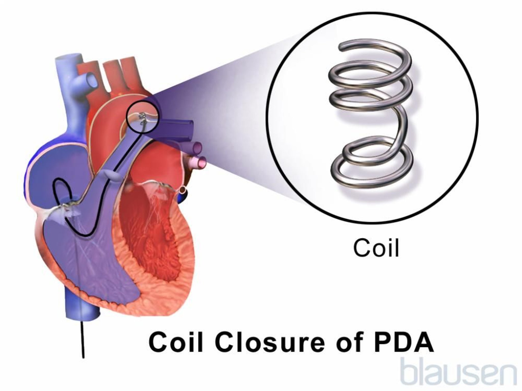Bằng sáng chế Ductus Arteriosus Coil Closure