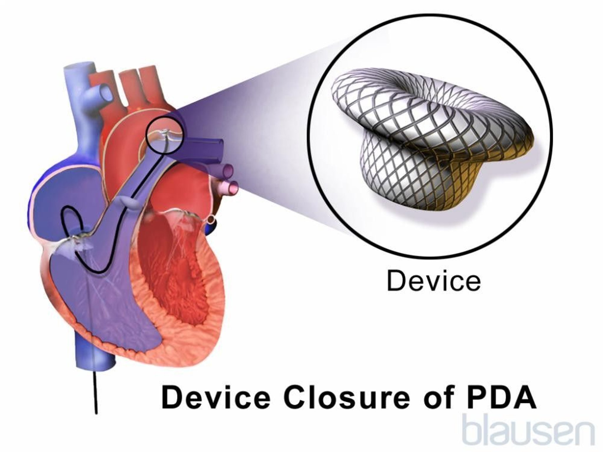 Patent Ductus Arteriosus Device Closure