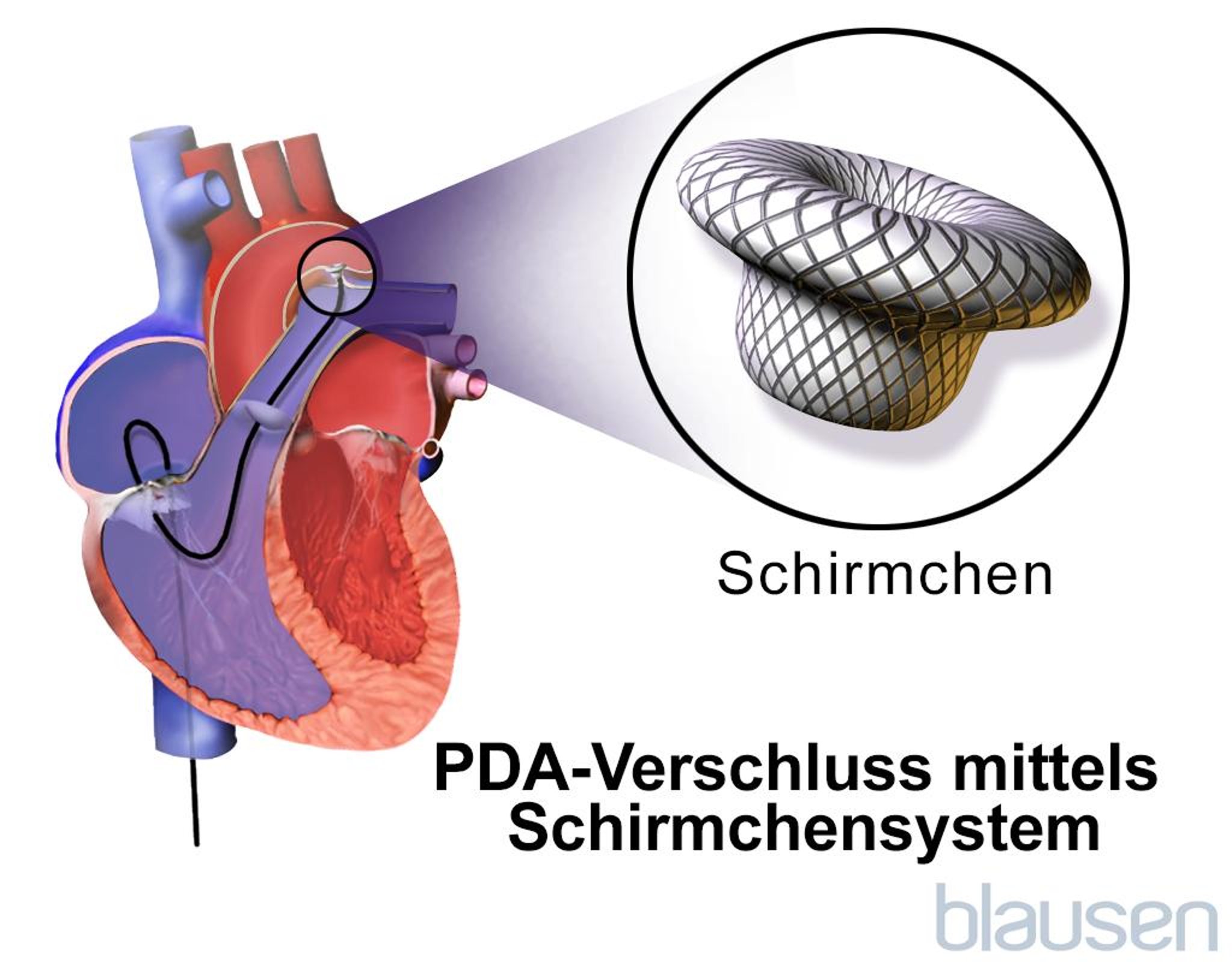 Geräteverschluss eines persistierenden Ductus arteriosus