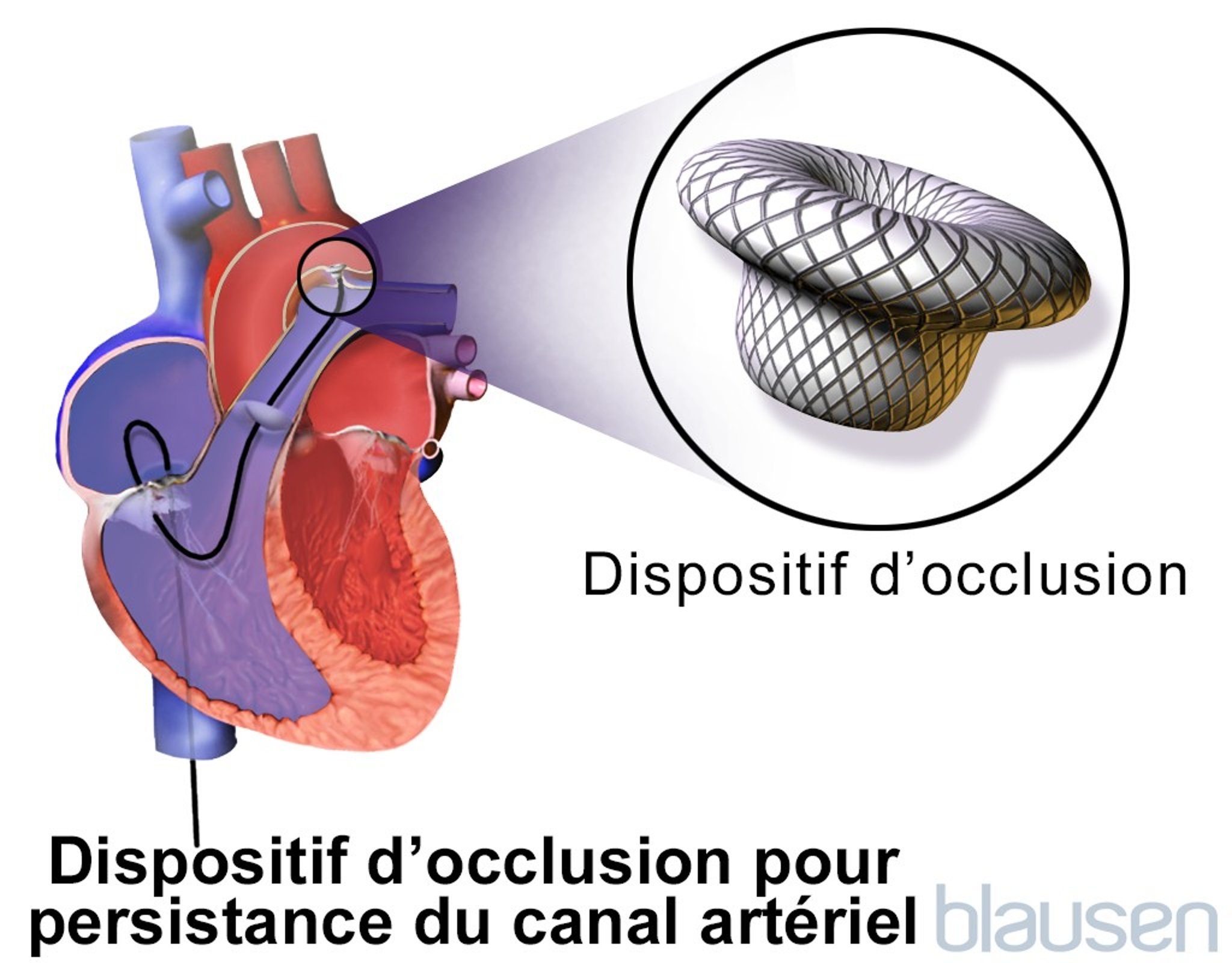 Dispositif de fermeture de la persistance du canal artériel