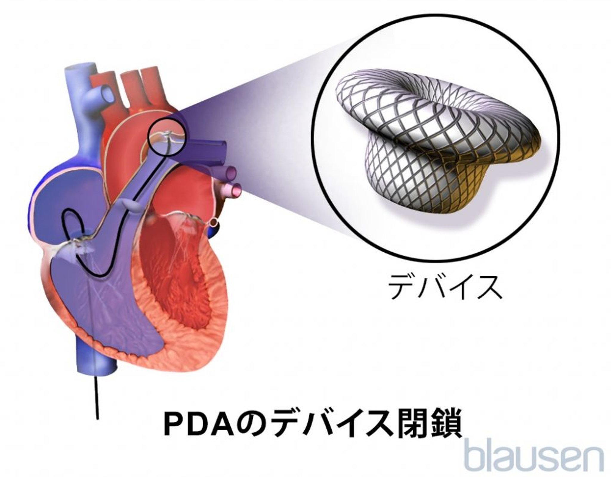 動脈管開存症のデバイス閉鎖術