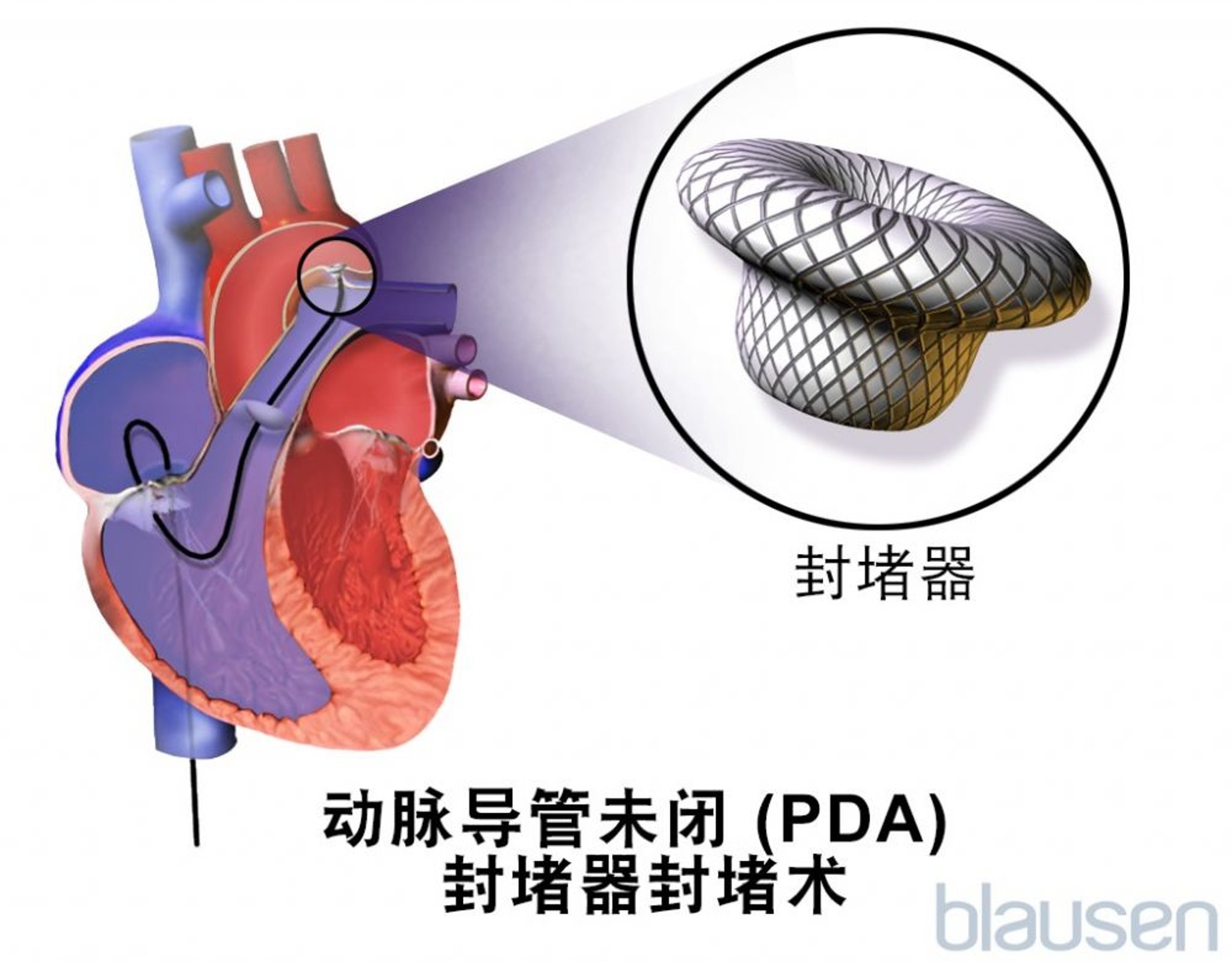 动脉导管未闭装置闭合