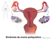 Síndrome de ovario poliquístico (SOP)
