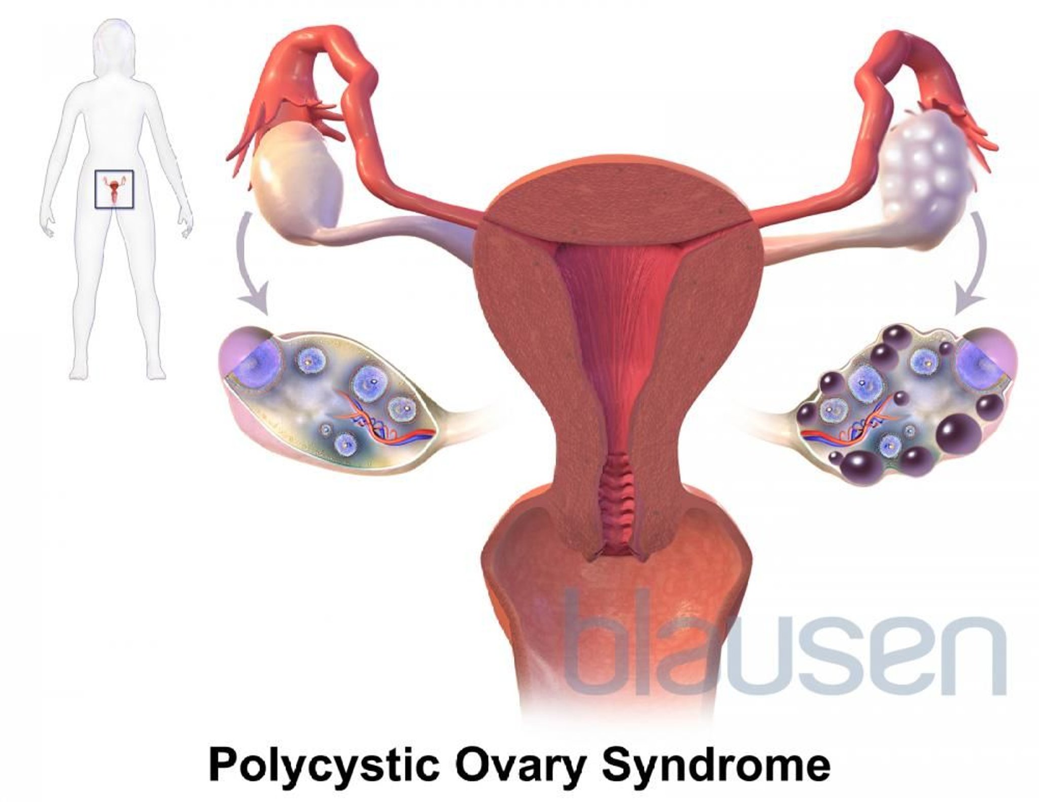 Hội chứng Buồng trứng Đa nang (PCOS)