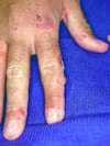 Porphyria Cutanea Tarda (Finger)