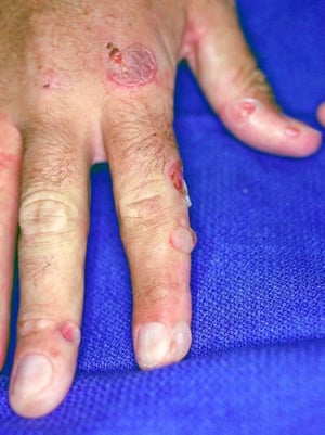 Porphyria Cutanea Tarda (Finger)