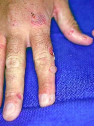 Поздняя кожная порфирия (палец)