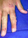 Porphyria Cutanea Tarda (Finger)