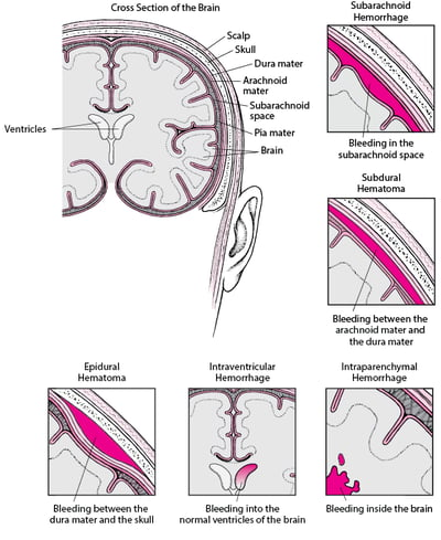 Types of Intracranial Hemorrhage