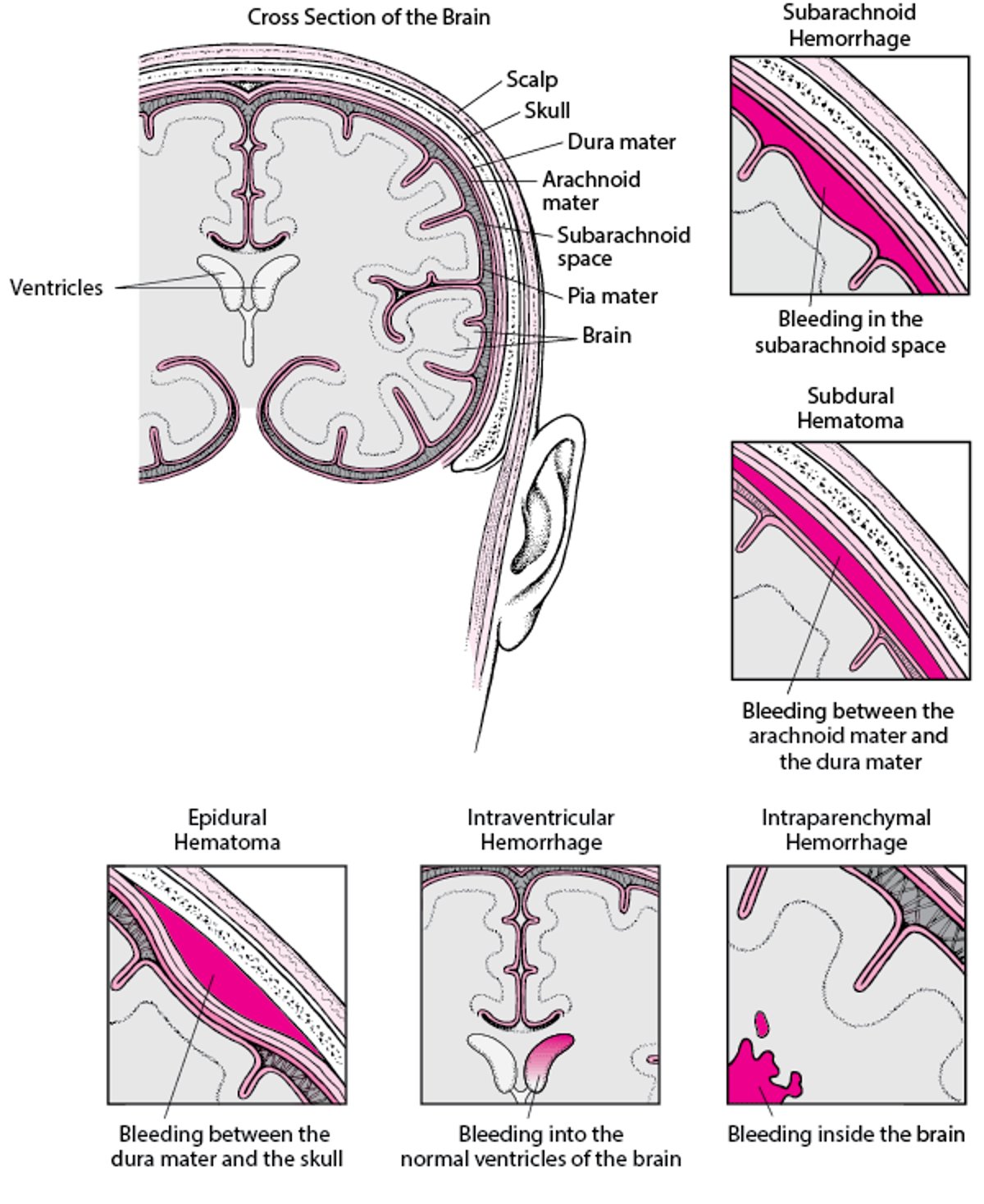 Types of Intracranial Hemorrhage