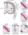 Tipos de hemorragia intracraneal