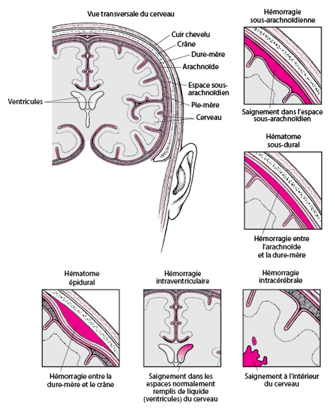 Types d'hémorragie intracrânienne