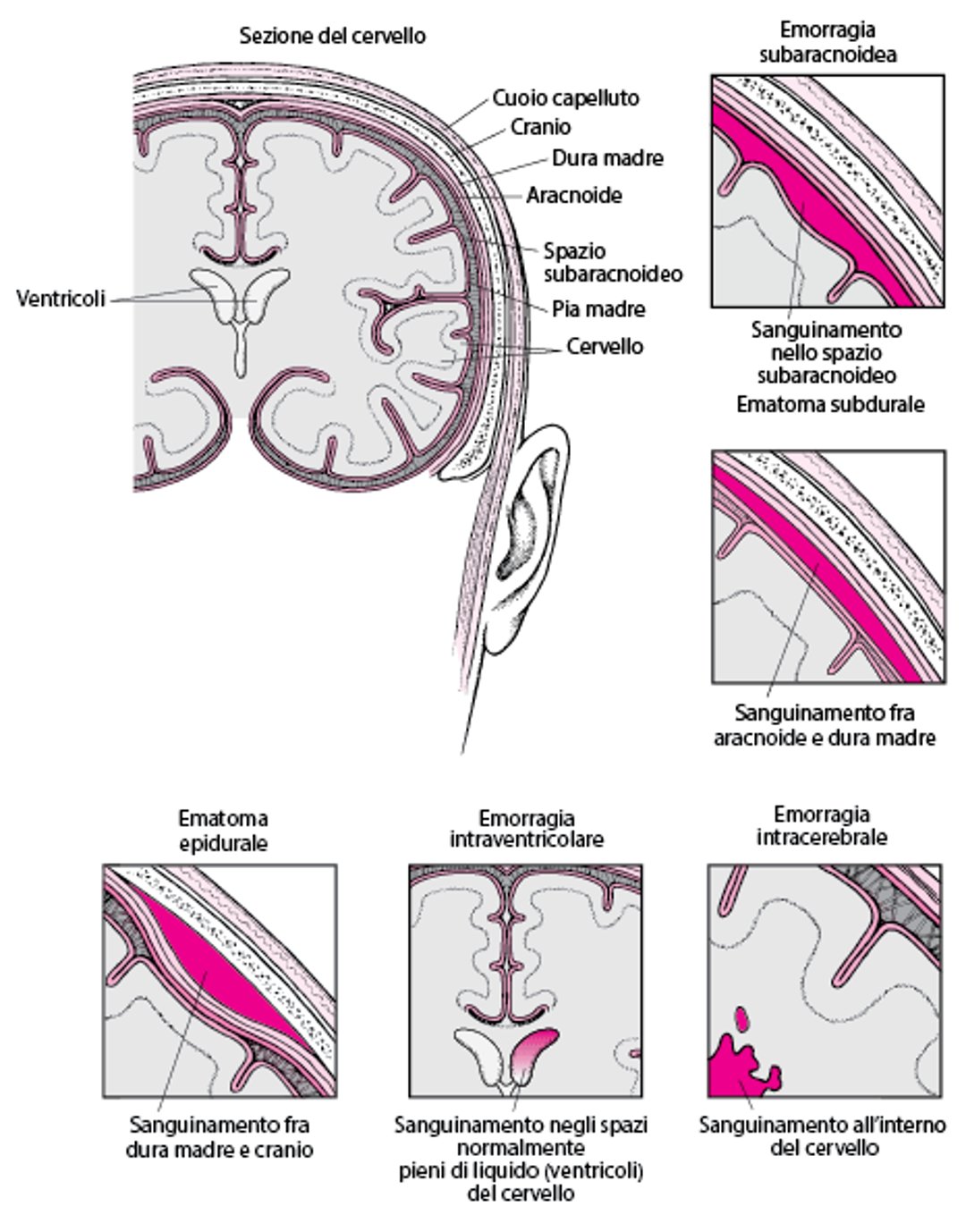 Tipi di emorragie endocraniche