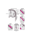 Tipos de hemorragia intracraniana