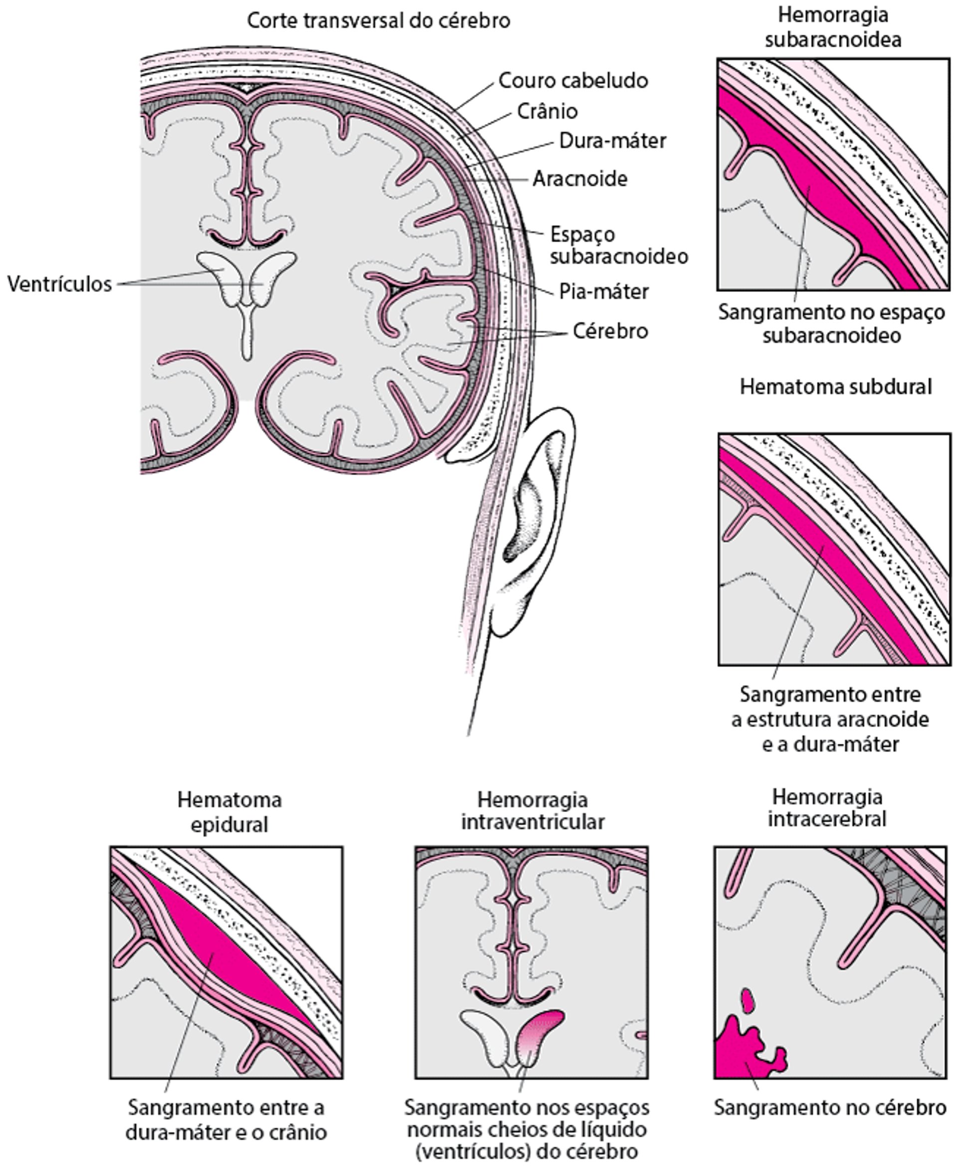 Tipos de hemorragia intracraniana
