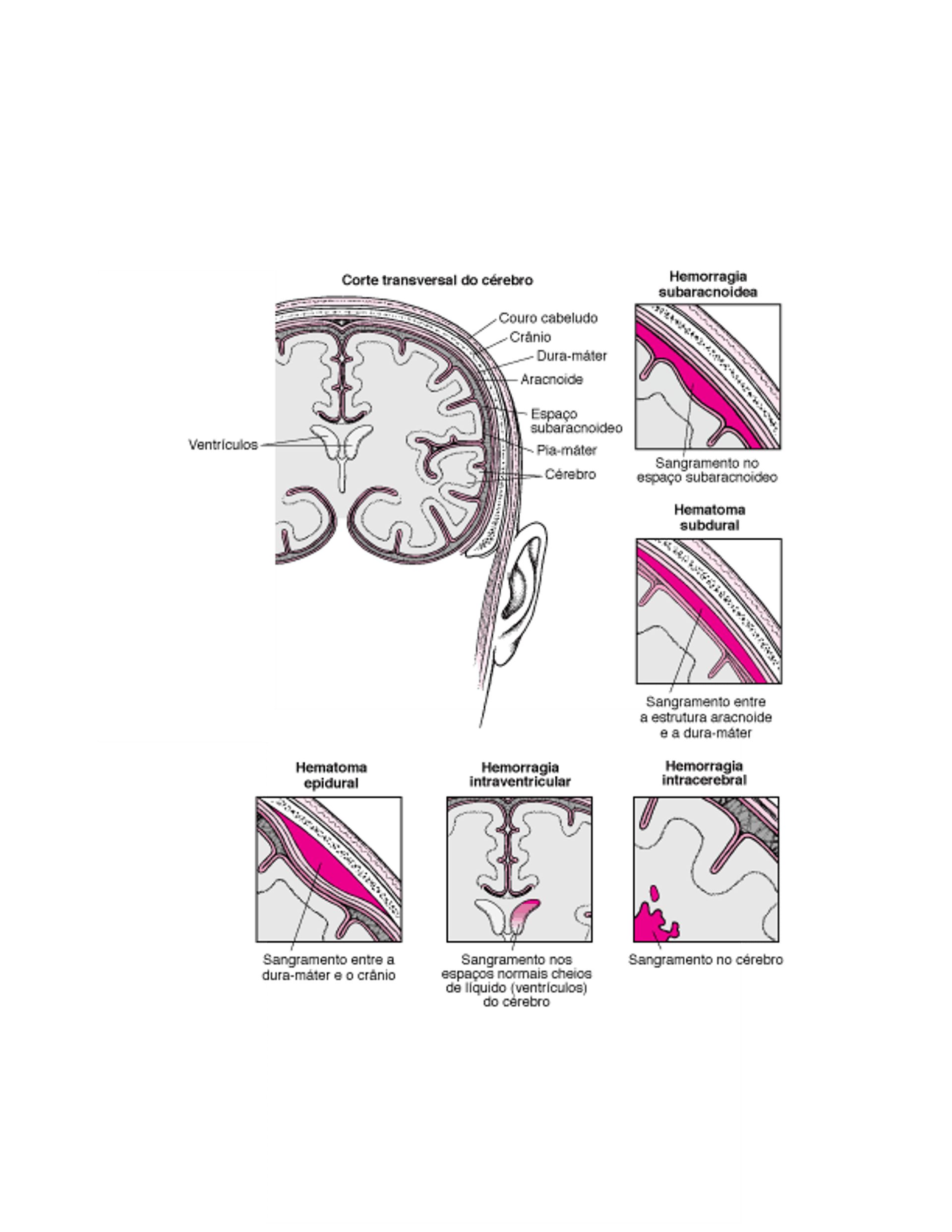 Tipos de hemorragia intracraniana