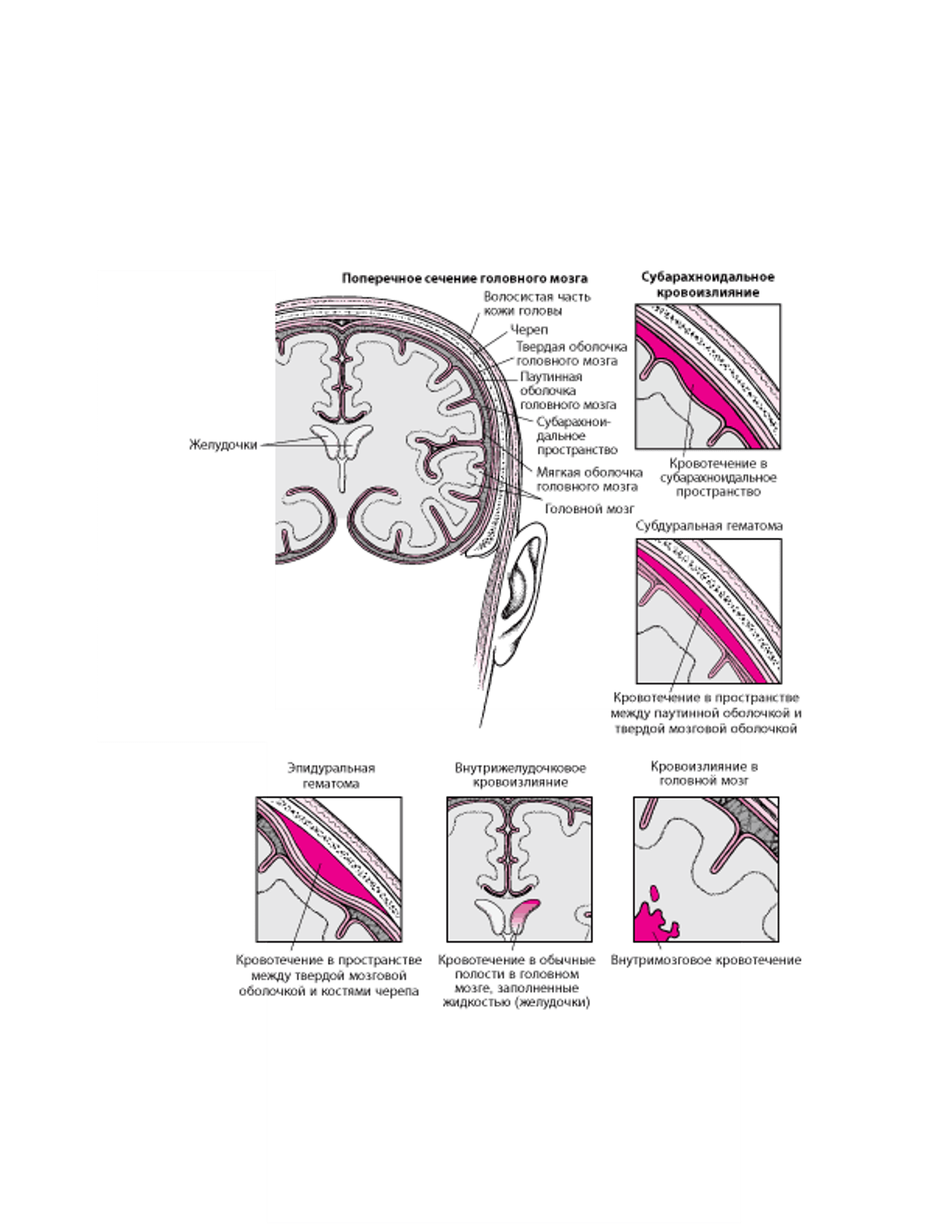 Типы внутричерепных кровоизлияний