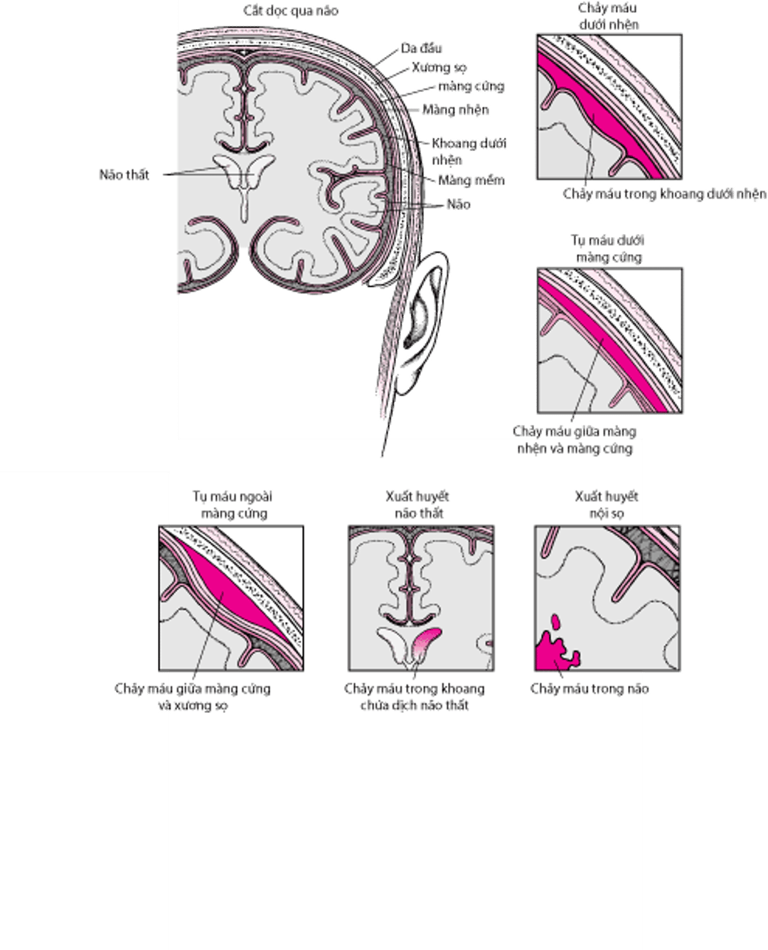 Các thể xuất huyết nội sọ