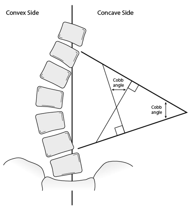 Image:Cobb angle-Merck Manual Consumer Version