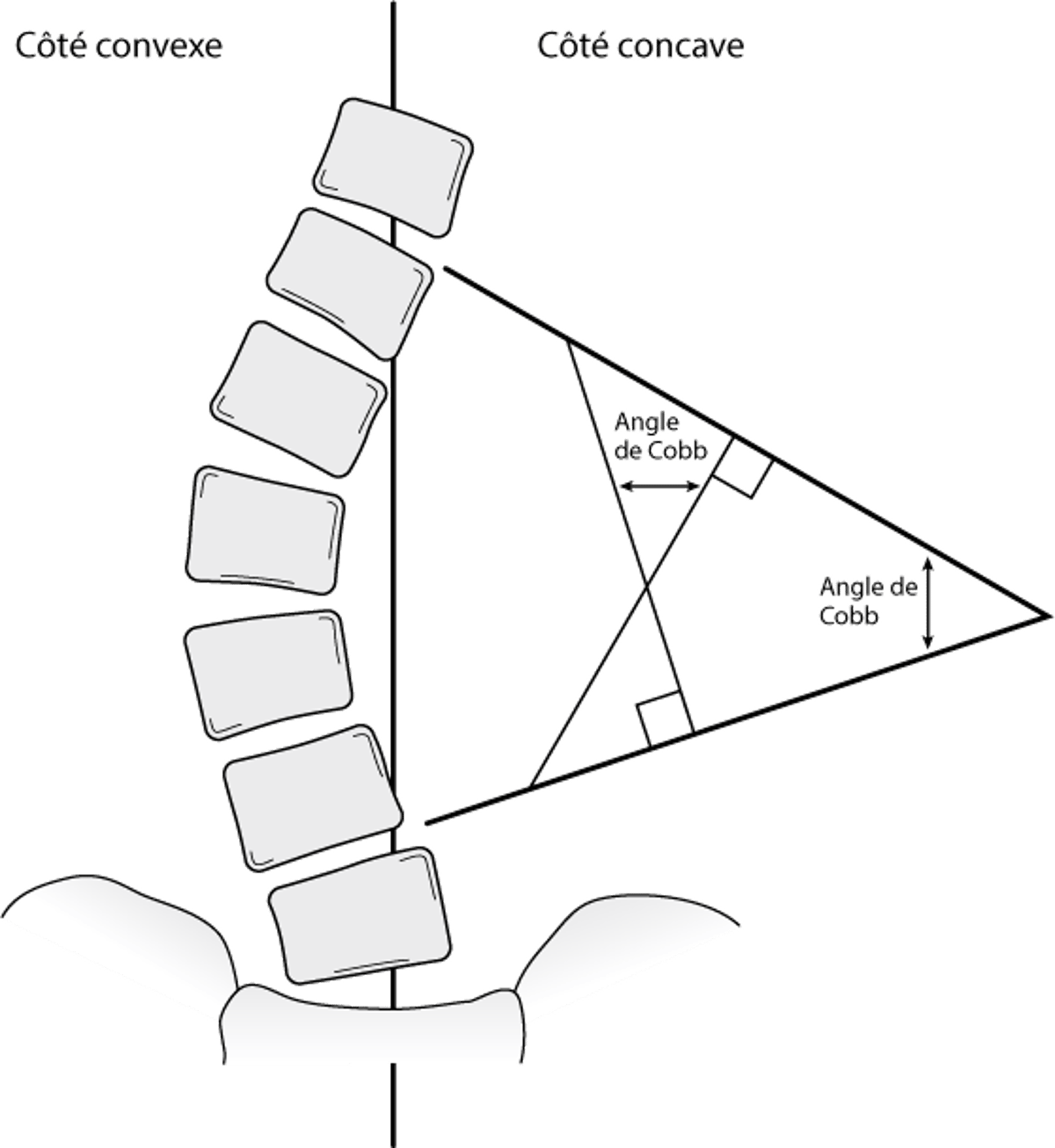 Angle de Cobb